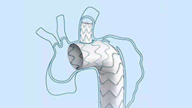 一體式人工血管術中支架系統(tǒng)（華脈泰科）